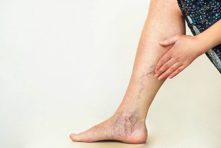 spider vein doctor in Indore, varicose veins treatment in Indore