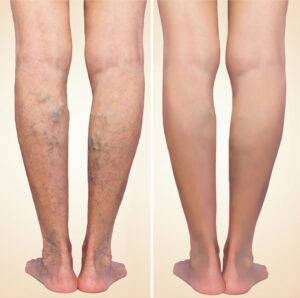 varicose veins treatment in indore