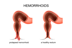 piles treatment in indore, piles doctor in indore