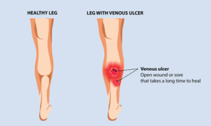 varicose veins treatment in indore