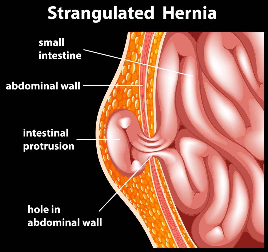 hernia treatment in Indore