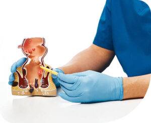 piles doctor in indore, piles treatment in indore