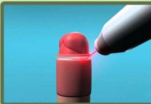 laser circumcision treatment in indore, circumcision treatment in indore