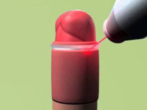 laser circumcision surgery in indore, circumcision by laser
