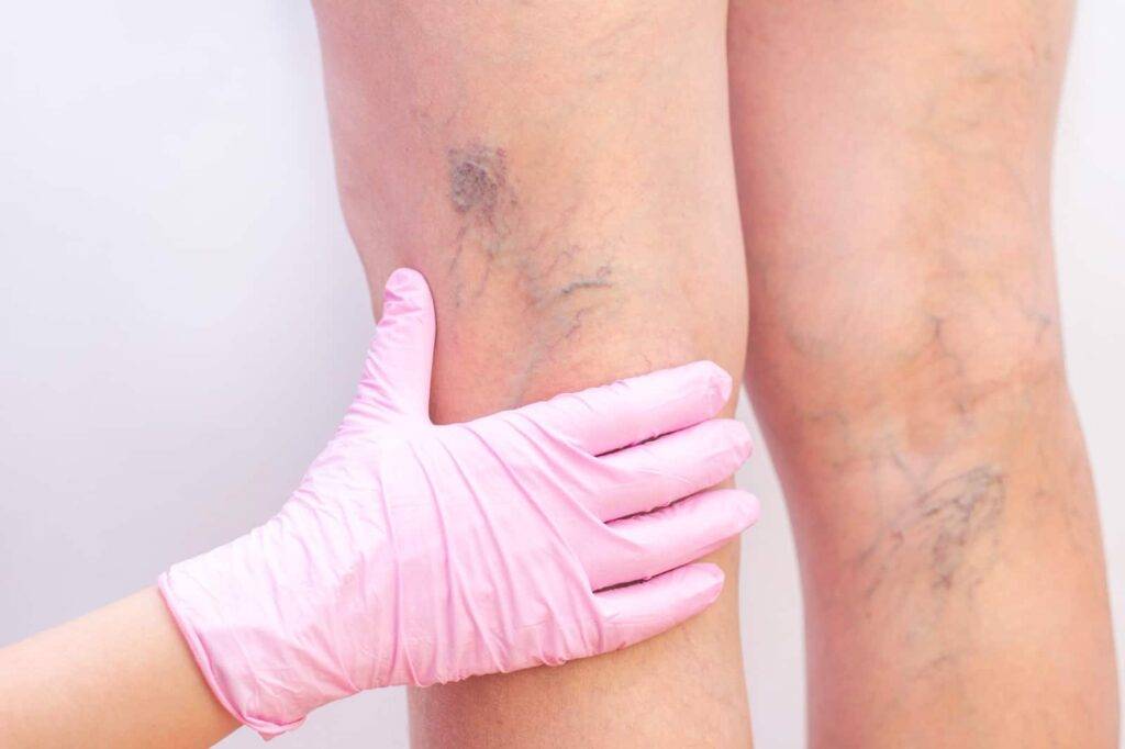 varicose veins treatment in indore, best varicose vein specialist in indore