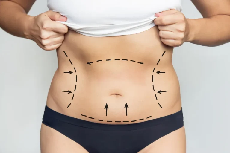liposuction surgery in indore, liposuction training in indore, liposuction in indore