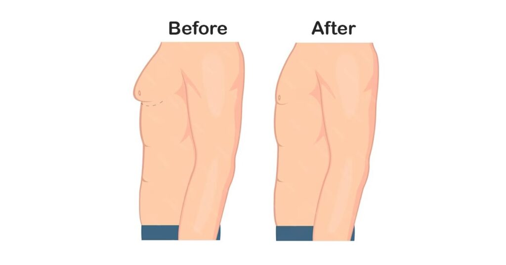 gynecomastia indore, गाइनेकोमास्टिया इंदौर