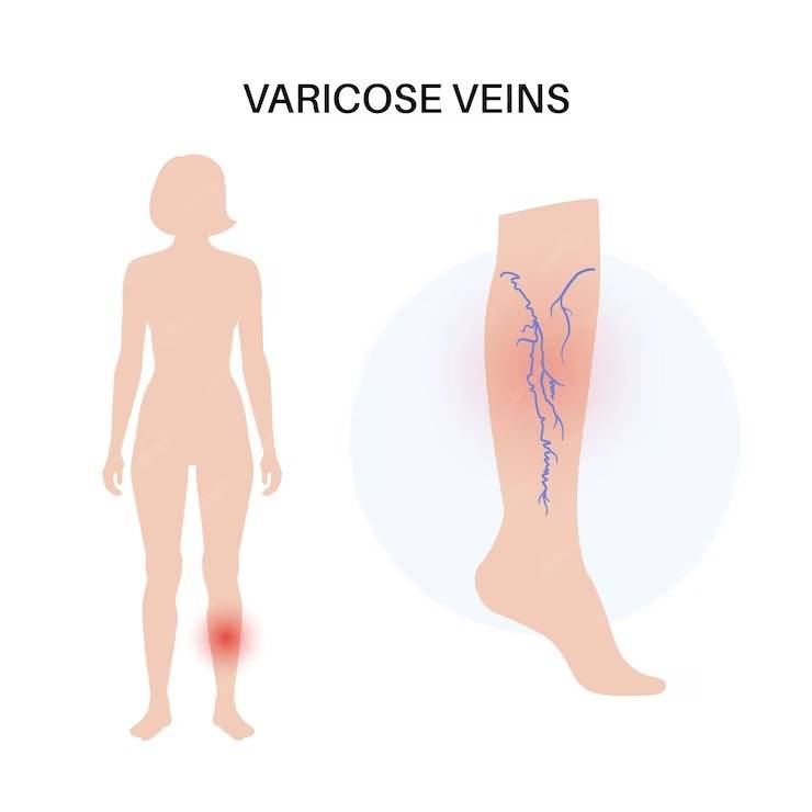 best varicose veins treatment indore