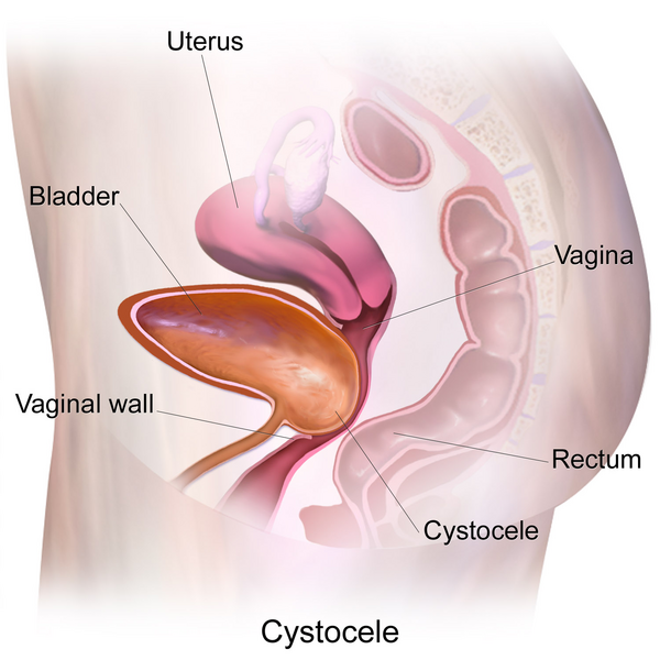 cystocele surgery in indore, cystocele in indore