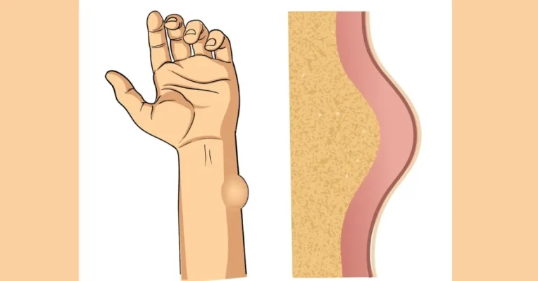 lipoma surgery in Indore