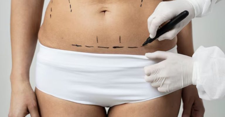 best liposuction procedure in Indore