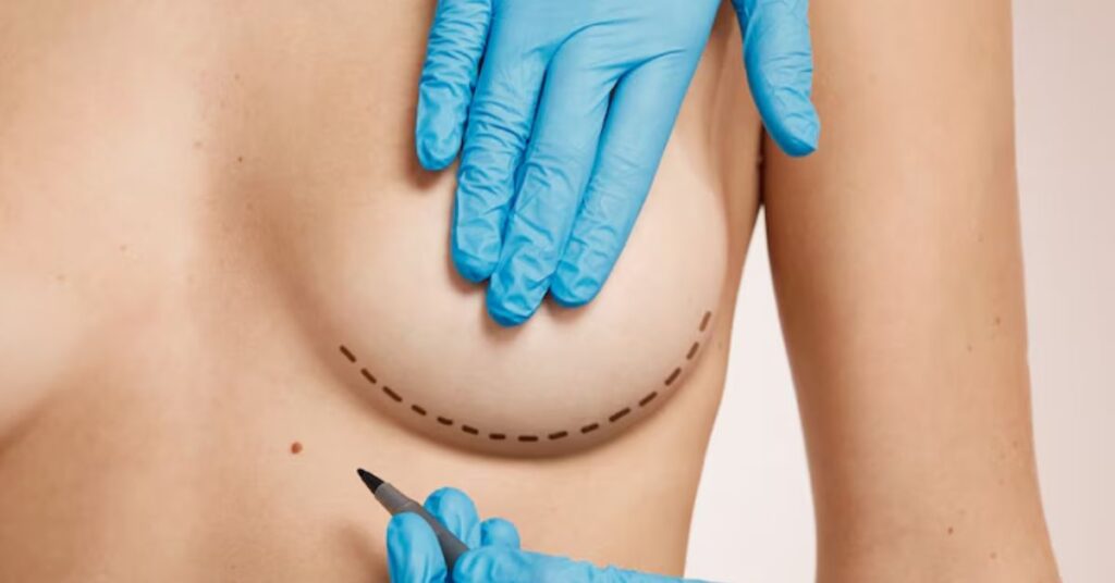 Lipoma Removal Surgery in Indore, Lipoma Removal Surgeon in Indore