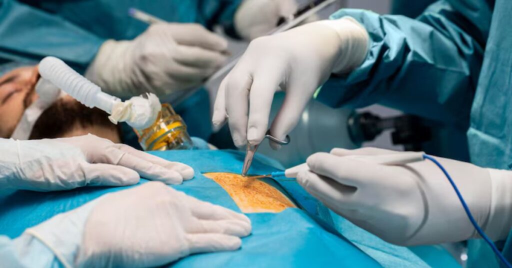 pilonidal sinus laser surgery in indore, pilonidal sinus treatment in indore