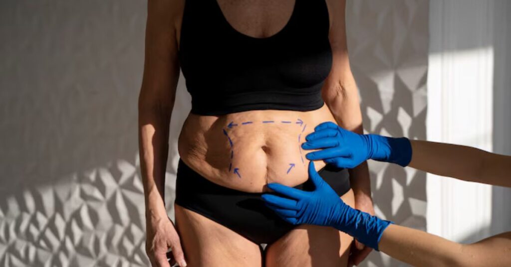 best fat removal surgery indore, fat removal surgery indore