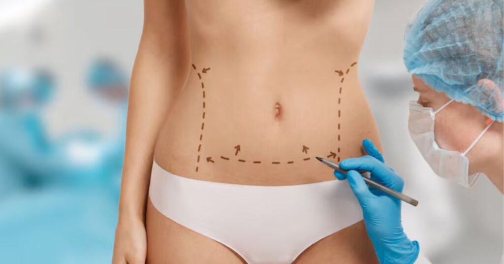 liposuction surgery in indore