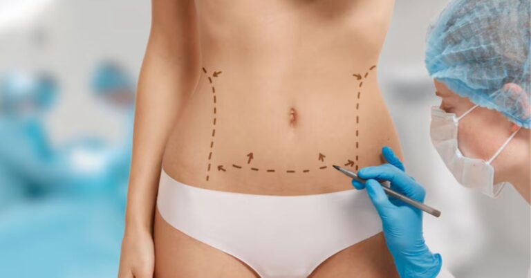 liposuction surgery in indore