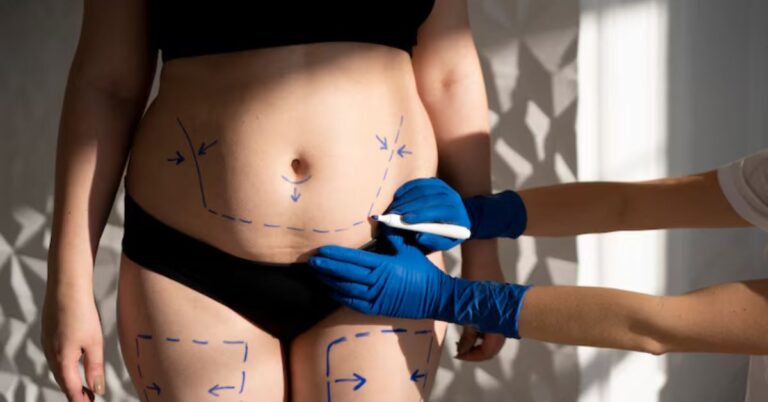 fat removal surgery in indore