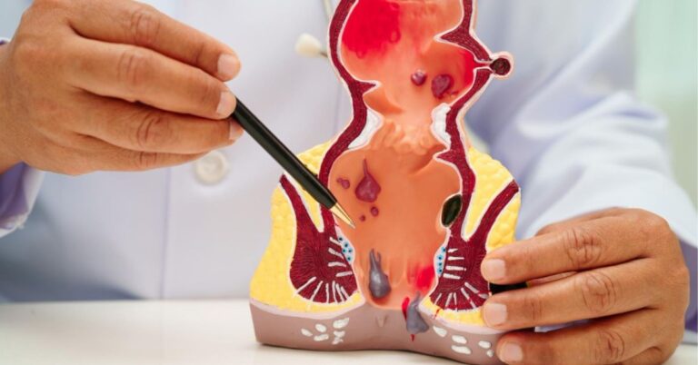 piles doctor in indore