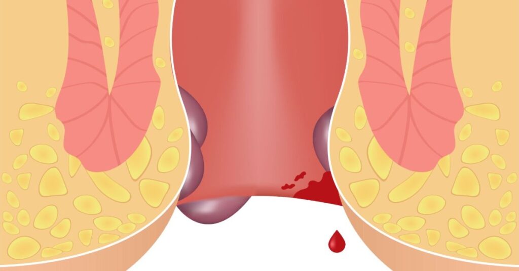 best piles doctor in indore