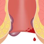 best piles doctor in indore