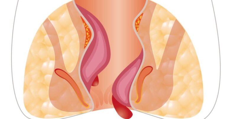 गुदा के पास गांठ