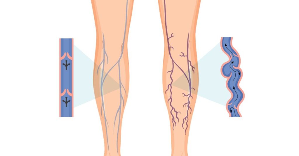 varicose veins doctor in indore