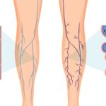 varicose veins doctor in indore