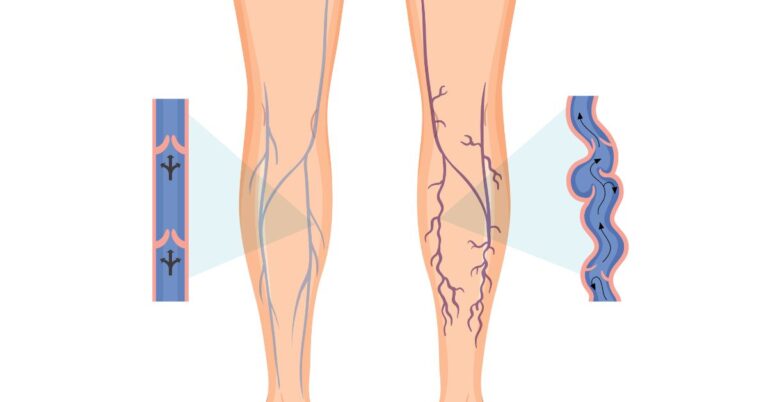 varicose veins doctor in indore